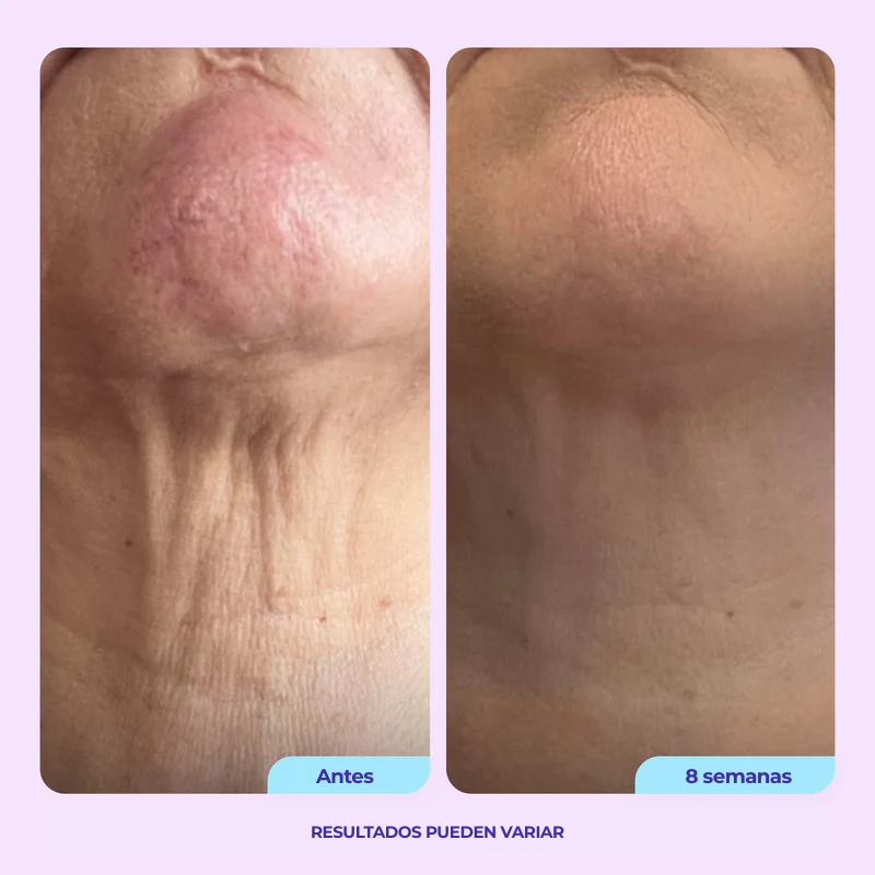 Crema Reafirmante para Cuello ProLift™